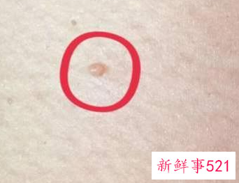 女性下面长了一个小肉粒是什么原因