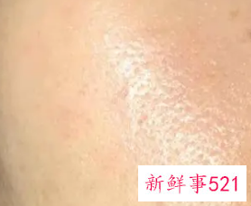 毛孔粗大怎么修复最好