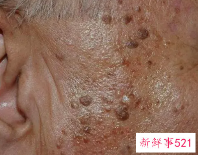 老人脸上长黑斑怎么办