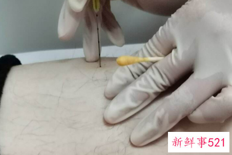 埋线减肥的风险有哪些