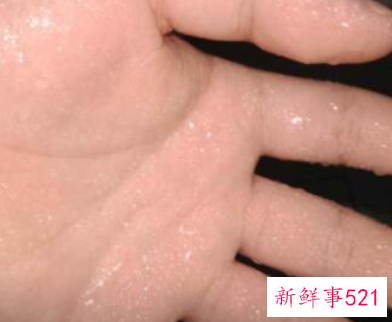 天热手心出汗是什么原因