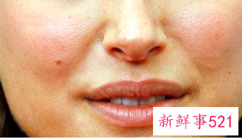 长了肿痛里面有脓的白色痘痘怎么办