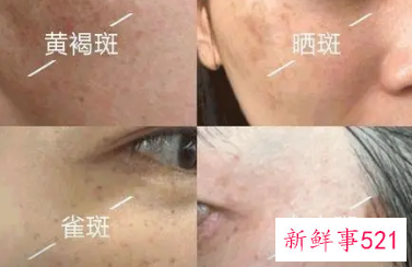 脸上有斑用什么办法能去掉