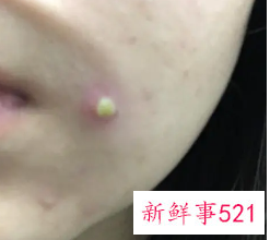 长了肿痛里面有脓的白色痘痘怎么办