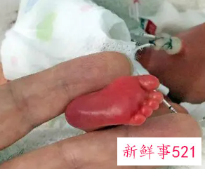 五个月早产活下来了