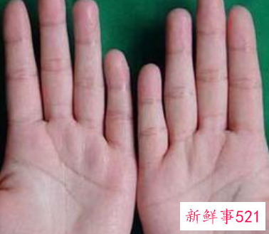天热手心出汗是什么原因