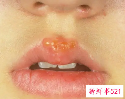 嘴上起泡怎么快速处理