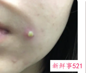 痘痘里面有白色的脓包