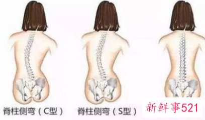脊柱侧弯成危害我国儿童青少年健康的第三大疾病