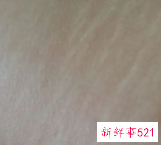 长肥胖纹的原因跟垃圾食品有关吗