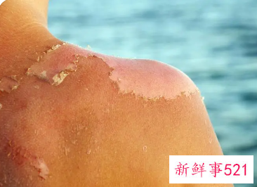 脸部晒伤了怎么快速修复