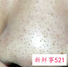 毛孔粗大怎么修复最好