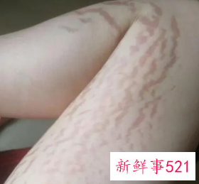 长肥胖纹的原因跟垃圾食品有关吗