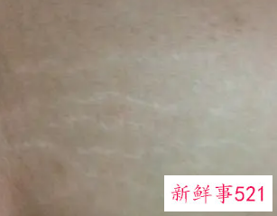 长肥胖纹的原因跟垃圾食品有关吗