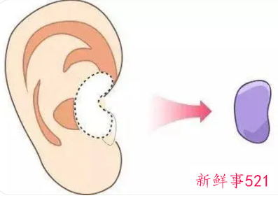 耳软骨隆鼻有什么后遗症