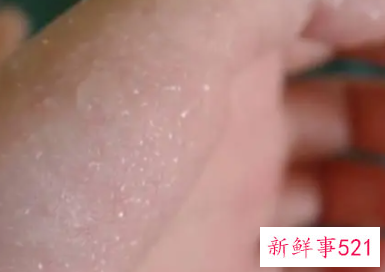 天热手心出汗是什么原因