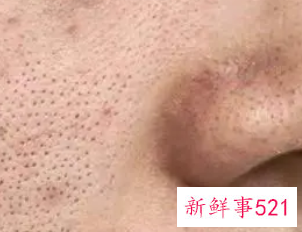 毛孔粗大怎么修复最好