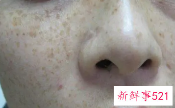 脸上有斑用什么办法能去掉