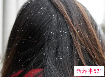 分享几个实用的去头屑小妙招