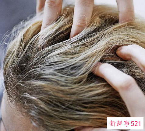 分享几个实用的去头屑小妙招