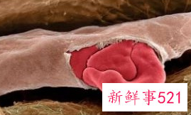 痘痘里面有白色的脓包