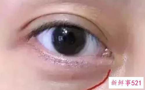 怎么去眼袋泪沟