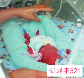 五个月早产活下来了