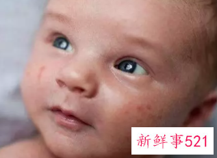 食物过敏是怎么回事