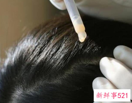 分享几个实用的去头屑小妙招