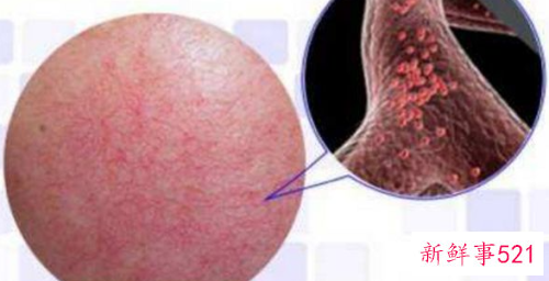 肌肤敏感该怎么办