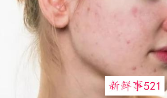 皮肤保护层受损表现