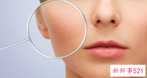 黑头毛孔大怎么办