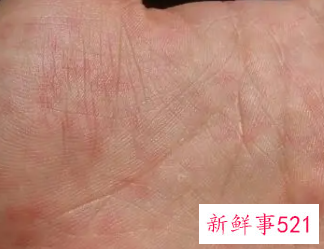 手心皮很硬很粗糙怎么回事