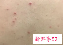 经常出汗的人对痘痘的好处