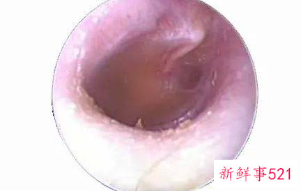 小儿耳朵里面痛是怎么回事