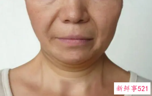 脸部往下垂怎么办