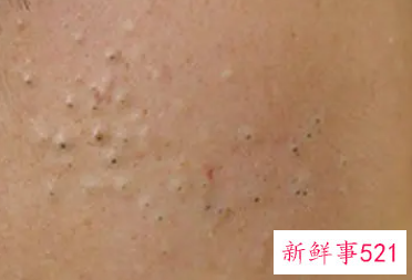 封闭性粉刺要不要挤