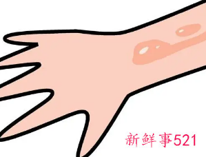 皮肤烫伤了在家里怎么处理