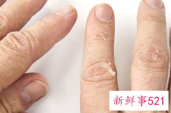 手指间起泡痒出水是怎么回事