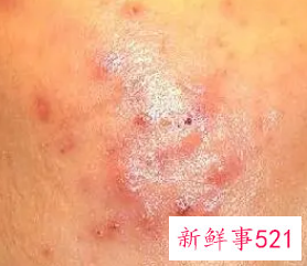 经常出汗的人对痘痘的好处