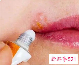 嘴角起泡要不要弄破