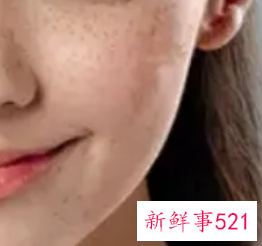 脸上很多雀斑该怎么办