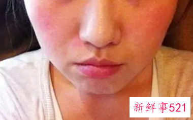 用过期护肤品脸红肿怎么办