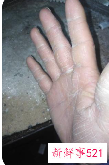 手心皮很硬很粗糙怎么回事