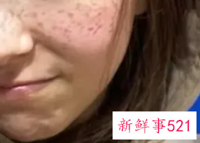 脸上很多雀斑该怎么办