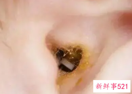 小儿耳朵里面痛是怎么回事