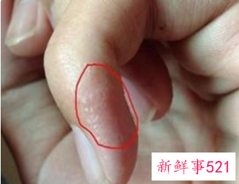 手指间起泡痒出水是怎么回事