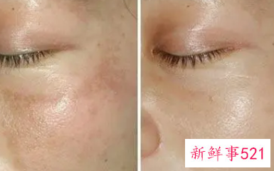 蝴蝶斑如何去除