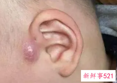 小儿耳朵里面痛是怎么回事