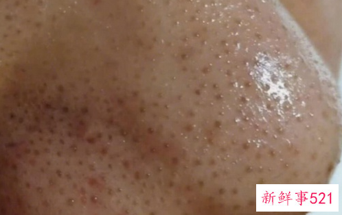 脸上每一个毛孔都能挤出白色的东西